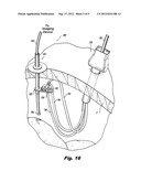 WIRE GUIDES AND ANCHORS FOR ENDOSCOPY diagram and image