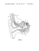 Line Transmission for Vibratory Actuation in Implantable Transducers diagram and image