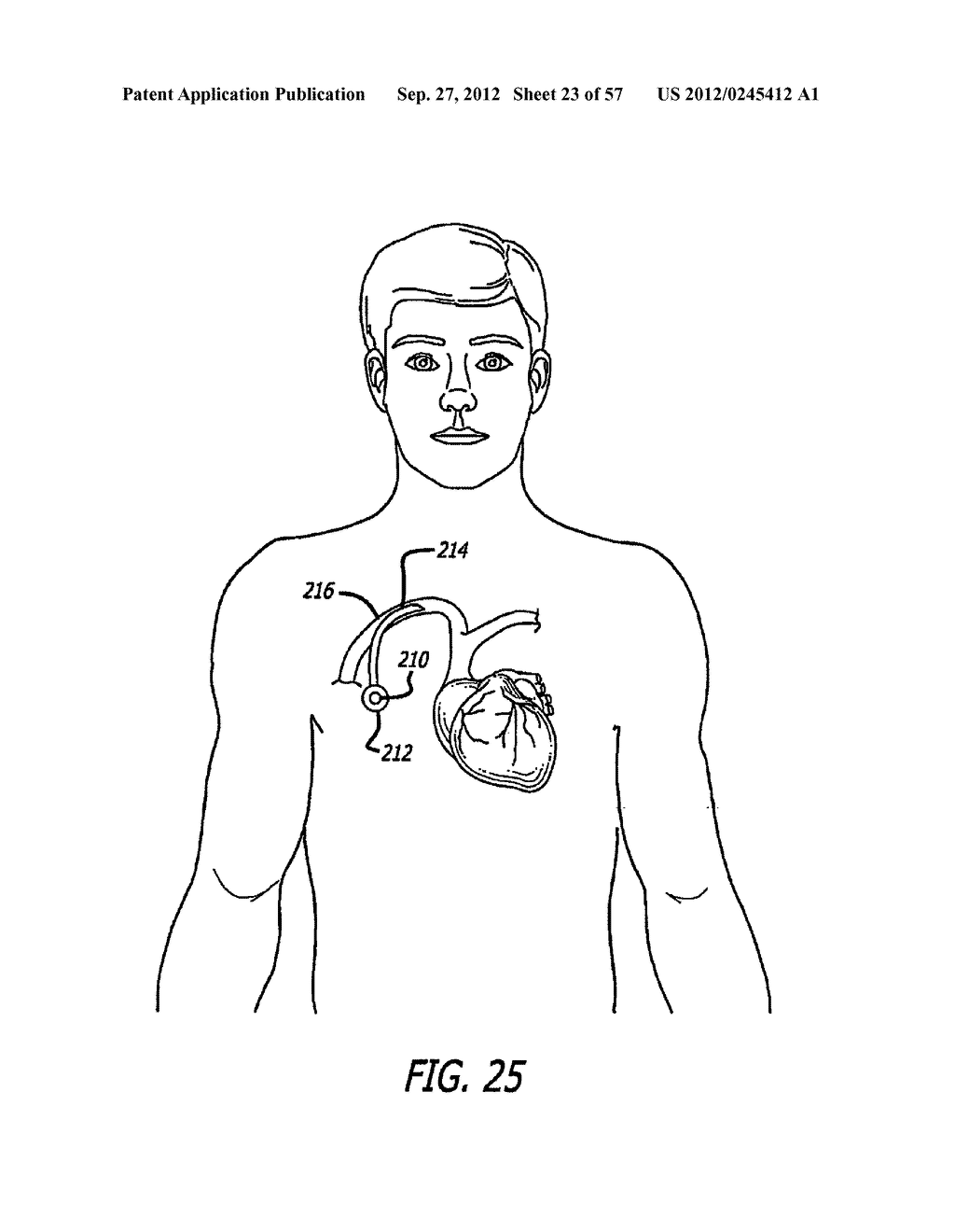 METHOD FOR MODULATING CHANGES IN INTRA-BAND PRESSURE IN A GASTRIC BAND - diagram, schematic, and image 24