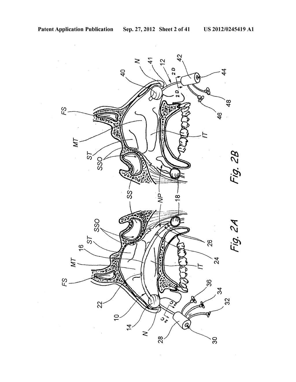 Devices, Systems and Methods For Diagnosing and Treating Sinusitis and     Other Disorders of the Ears, Nose and/or Throat - diagram, schematic, and image 03