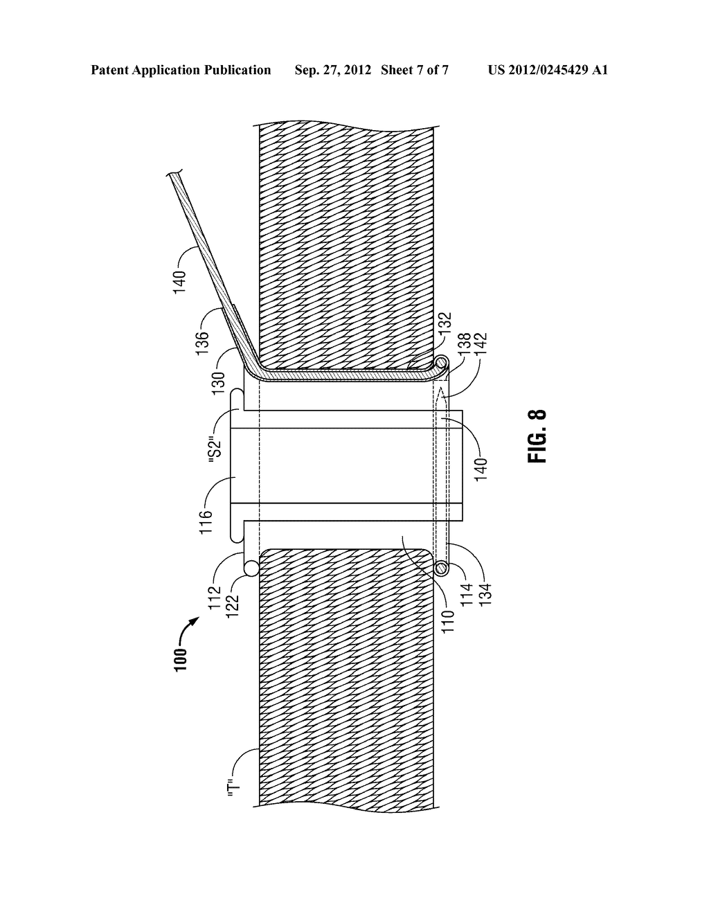 WOUND PROTECTOR INCLUDING POCKET FOR REUSABLE DISTAL RING - diagram, schematic, and image 08