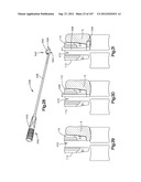 Spinal Access Retractor diagram and image