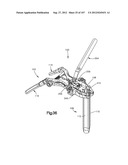 Spinal Access Retractor diagram and image