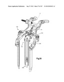 Spinal Access Retractor diagram and image