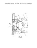 Spinal Access Retractor diagram and image