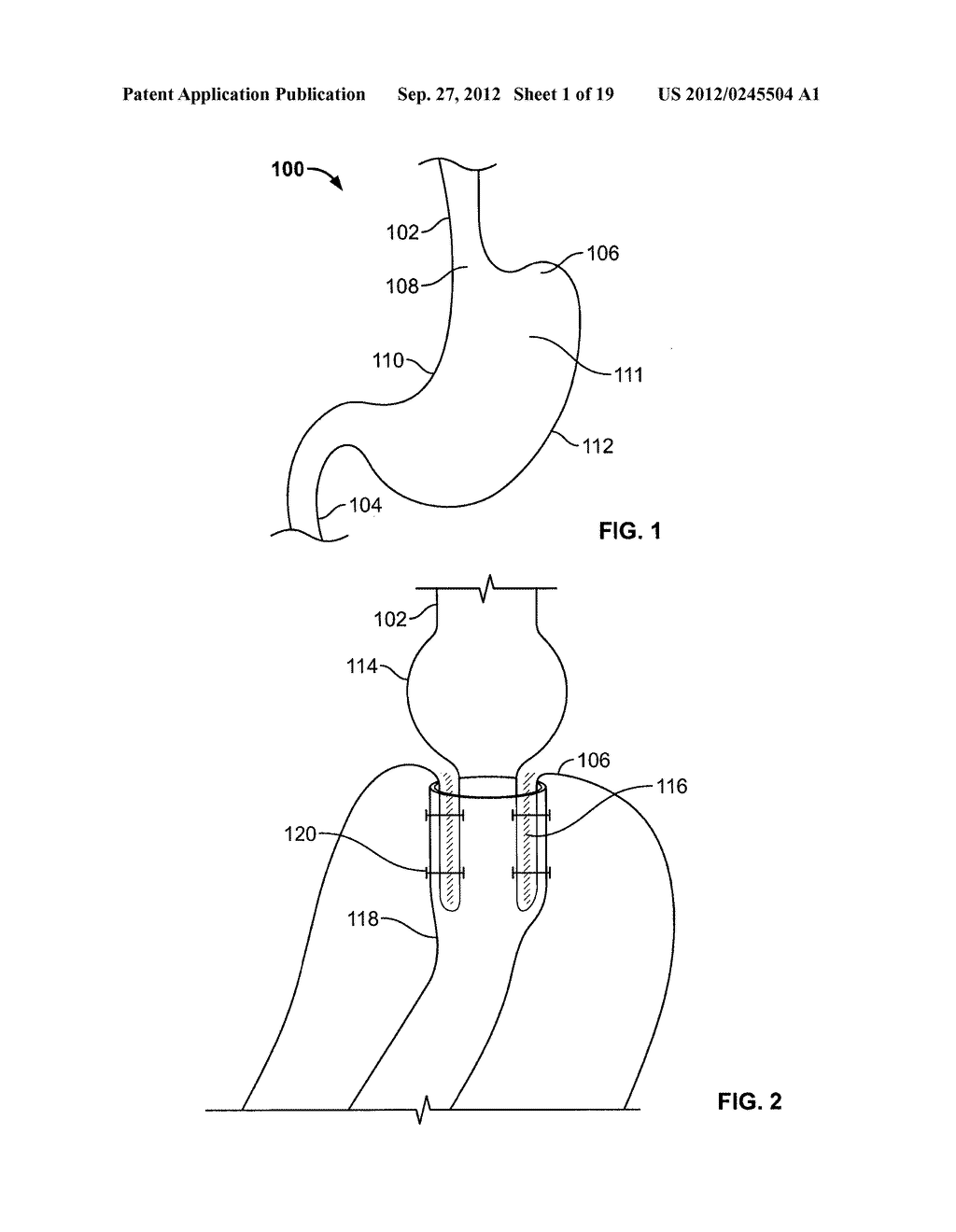 DEVICES AND METHODS TO DELIVER, RETAIN AND REMOVE A SEPARATING DEVICE IN     AN INTUSSUSCEPTED HOLLOW ORGAN - diagram, schematic, and image 02