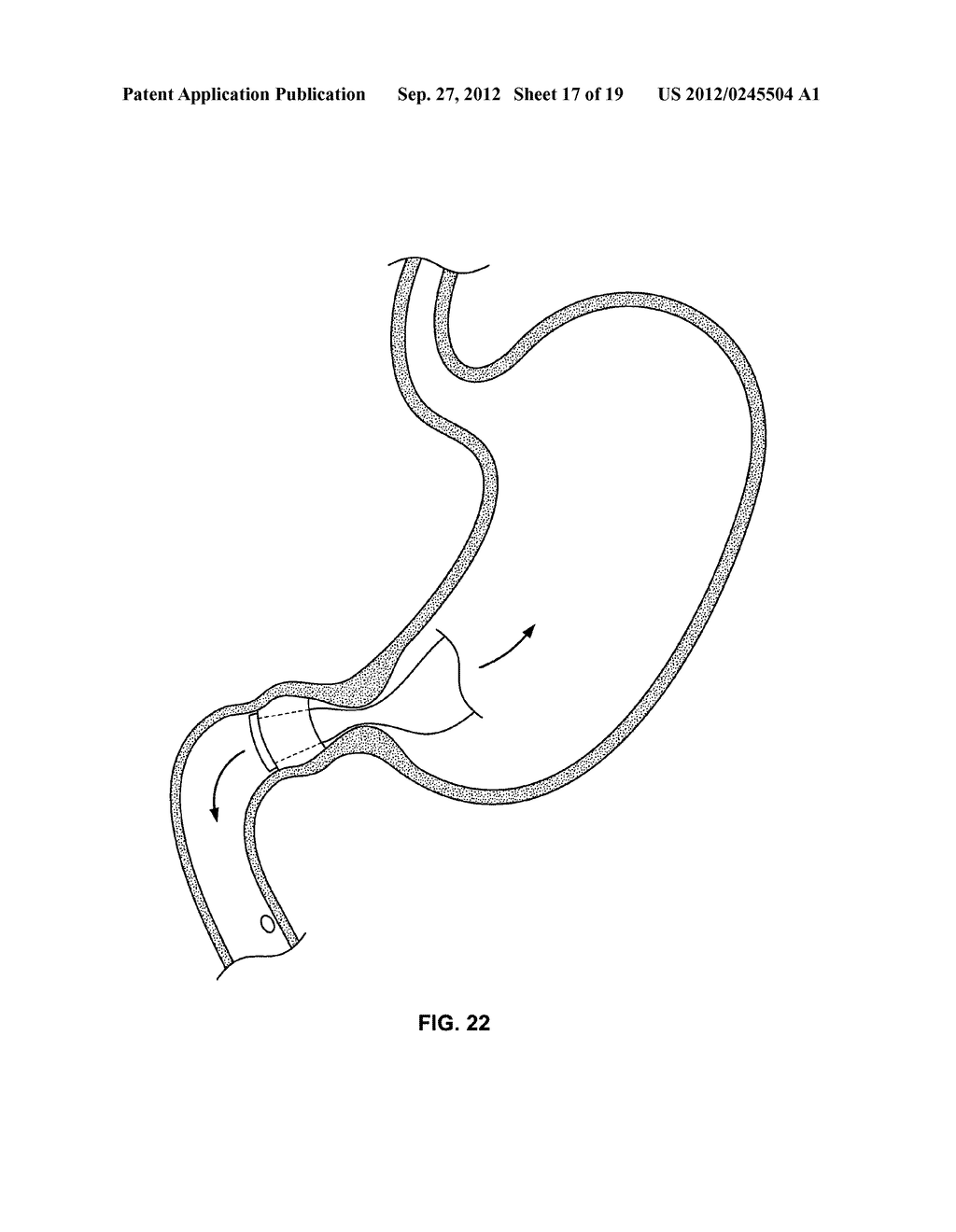 DEVICES AND METHODS TO DELIVER, RETAIN AND REMOVE A SEPARATING DEVICE IN     AN INTUSSUSCEPTED HOLLOW ORGAN - diagram, schematic, and image 18