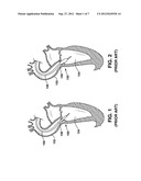 SPIRAL PERFUSION DILATATION BALLOON FOR USE IN VALVULOPLASTY PROCEDURE diagram and image