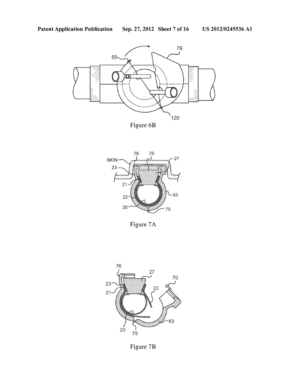 IMPLANTABLE VASCULAR ACCESS SYSTEM - diagram, schematic, and image 08