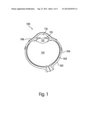 LACRIMAL IMPLANTS INCLUDING SPLIT AND INSERTABLE DRUG CORE diagram and image