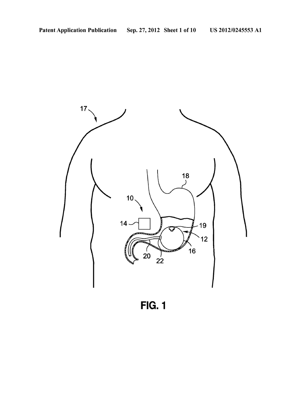 INTRAGASTRIC VOLUME OCCUPYING DEVICE WITH ACTIVE AGENTS - diagram, schematic, and image 02