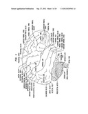 INTRAVENTRICULAR DRUG DELIVERY SYSTEM FOR IMPROVING OUTCOME AFTER A BRAIN     INJURY AFFECTING CEREBRAL BLOOD FLOW diagram and image