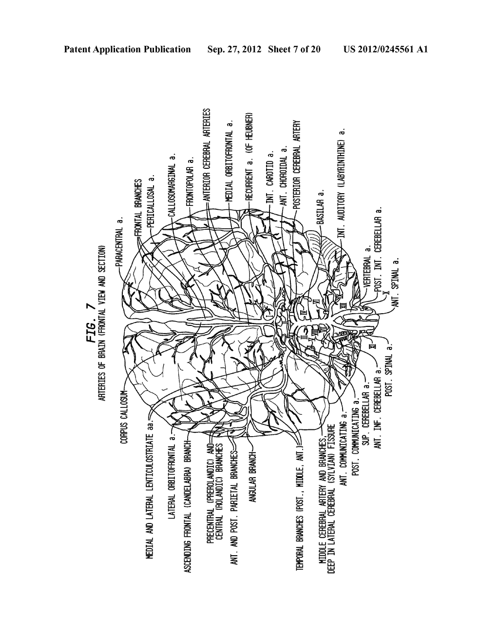 INTRAVENTRICULAR DRUG DELIVERY SYSTEM FOR IMPROVING OUTCOME AFTER A BRAIN     INJURY AFFECTING CEREBRAL BLOOD FLOW - diagram, schematic, and image 08