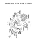 INTRAVENTRICULAR DRUG DELIVERY SYSTEM FOR IMPROVING OUTCOME AFTER A BRAIN     INJURY AFFECTING CEREBRAL BLOOD FLOW diagram and image