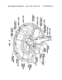 INTRAVENTRICULAR DRUG DELIVERY SYSTEM FOR IMPROVING OUTCOME AFTER A BRAIN     INJURY AFFECTING CEREBRAL BLOOD FLOW diagram and image