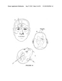 INTRAVENTRICULAR DRUG DELIVERY SYSTEM FOR IMPROVING OUTCOME AFTER A BRAIN     INJURY AFFECTING CEREBRAL BLOOD FLOW diagram and image