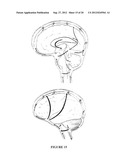 INTRAVENTRICULAR DRUG DELIVERY SYSTEM FOR IMPROVING OUTCOME AFTER A BRAIN     INJURY AFFECTING CEREBRAL BLOOD FLOW diagram and image