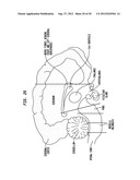 INTRAVENTRICULAR DRUG DELIVERY SYSTEM FOR IMPROVING OUTCOME AFTER A BRAIN     INJURY AFFECTING CEREBRAL BLOOD FLOW diagram and image