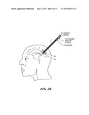 Cooled Laser Fiber for Improved Thermal Therapy diagram and image