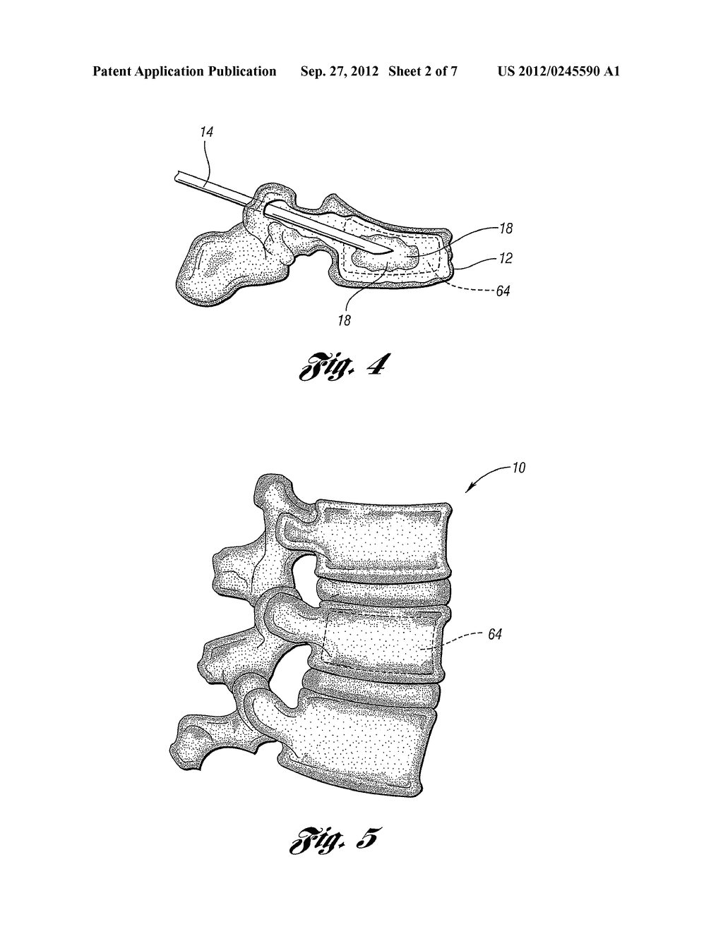 APPARATUS AND METHOD FOR MIXING AND DISPENSING A BONE CEMENT MIXTURE - diagram, schematic, and image 03