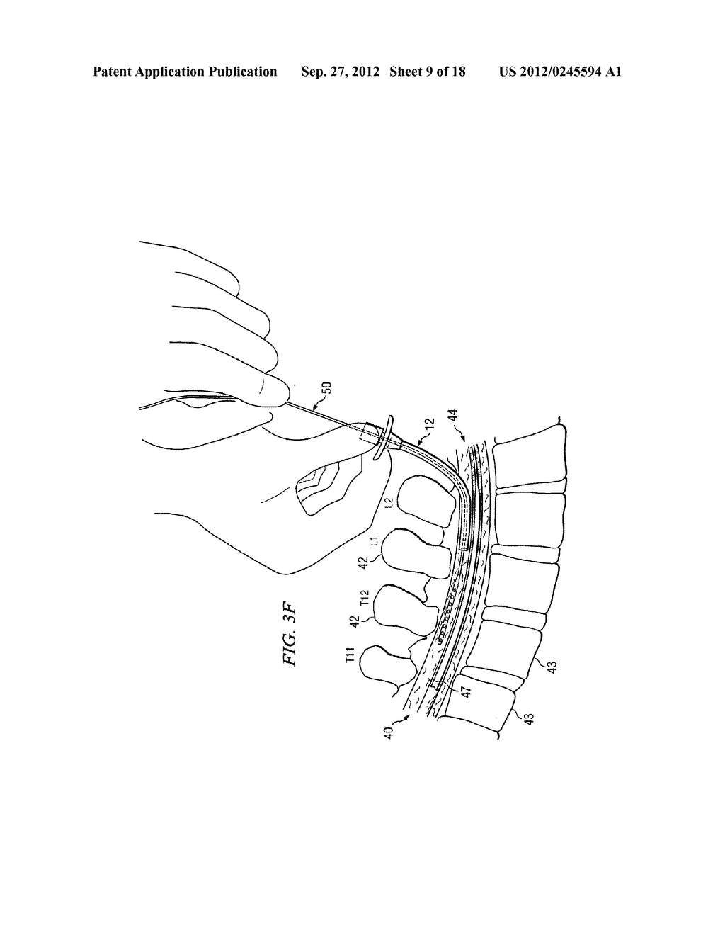 APPARATUS FOR IMPLANTING AN ELECTRICAL STIMULATION LEAD - diagram, schematic, and image 10