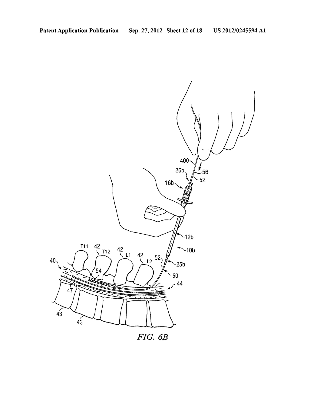 APPARATUS FOR IMPLANTING AN ELECTRICAL STIMULATION LEAD - diagram, schematic, and image 13