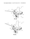 NAVIGATION AND POSITIONING SYSTEMS AND GUIDE INSTRUMENTS FOR JOINT REPAIR diagram and image