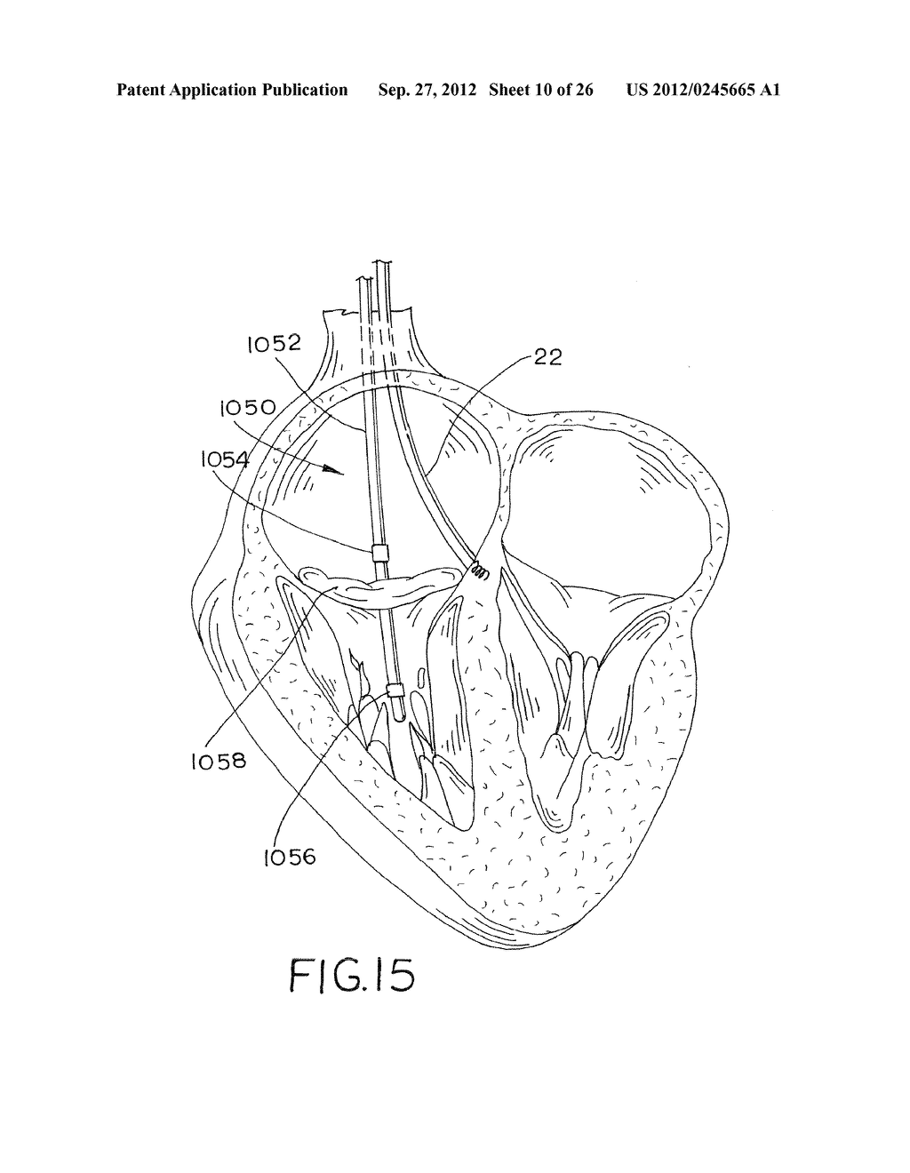 Pacing, Sensing or Defibrillator Leads for Implantation into the     Myocardium - diagram, schematic, and image 11