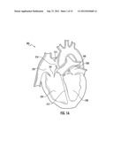 DEVICE AND METHOD FOR DELIVERING A VASCULAR DEVICE diagram and image