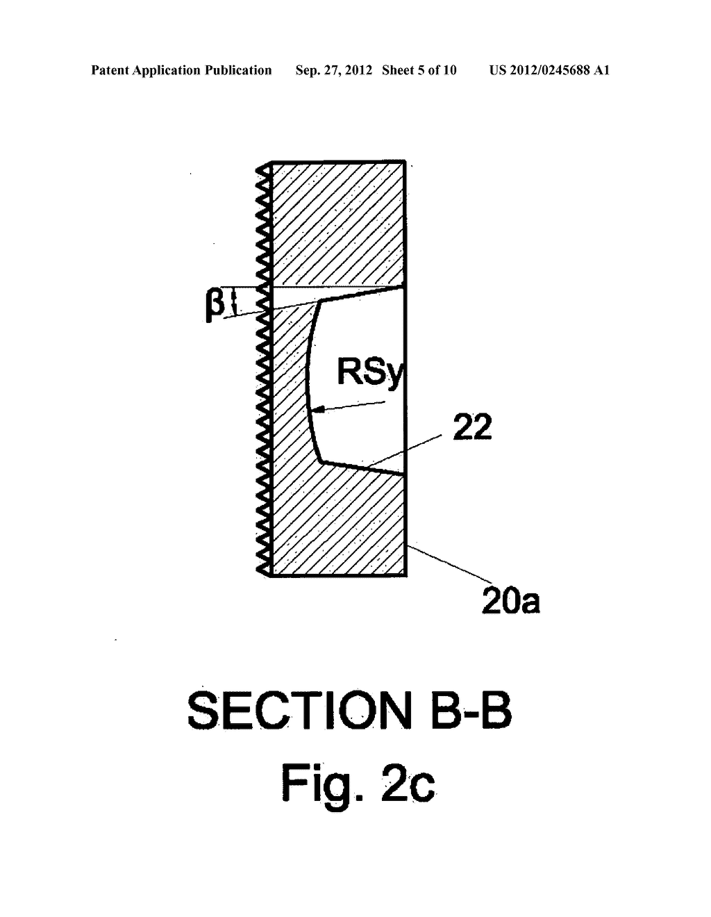 Universal disc prosthesis - diagram, schematic, and image 06