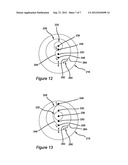 SHOULDER PROSTHESIS diagram and image