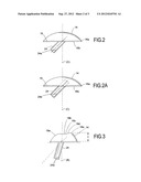 Hemi Ankle Implant diagram and image