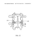 SLEEVE FOR BONE FIXATION DEVICE diagram and image