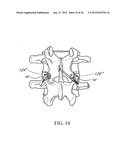 SLEEVE FOR BONE FIXATION DEVICE diagram and image