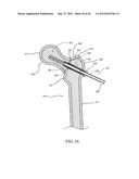 SLEEVE FOR BONE FIXATION DEVICE diagram and image