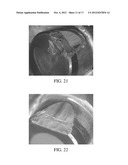 CUTTING ELEMENT HAVING MODIFIED SURFACE diagram and image