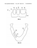 Method of Forming Patient Specific Implants with Improved Osseointegration diagram and image