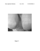 TRIPTANS FOR THE TREATMENT OF PSORIASIS diagram and image