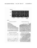 MITF AS A MARKER FOR PREDISPOSITION TO CANCER diagram and image