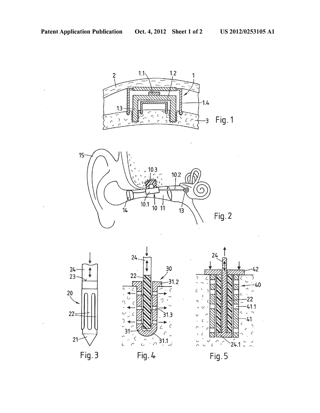 METHOD OF ANCHORING AN ACOUSTIC ELEMENT IN A BONE OF THE     CRANIOMAXILLOFACIAL REGION AND ACOUSTIC ELEMENT - diagram, schematic, and image 02