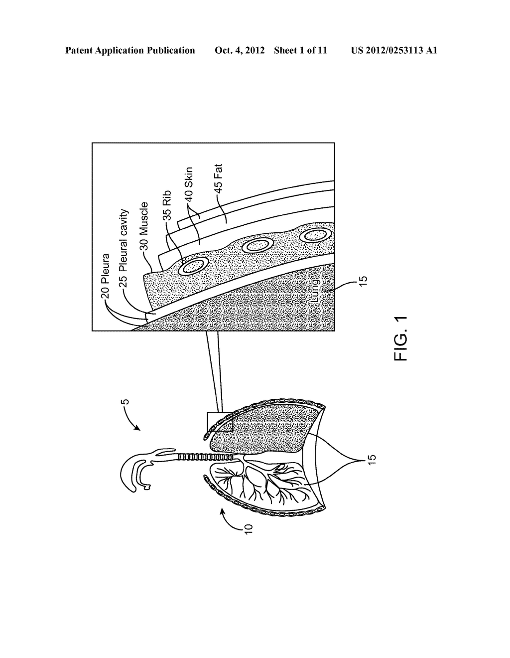 Devices, Systems, and Methods for Removing Empyema from a Pleural Cavity - diagram, schematic, and image 02