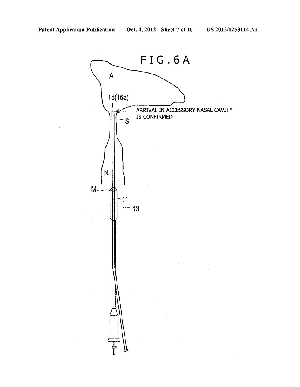 OTORHINOLARYNGOLOGICAL TREATMENT DEVICE AND METHOD - diagram, schematic, and image 08