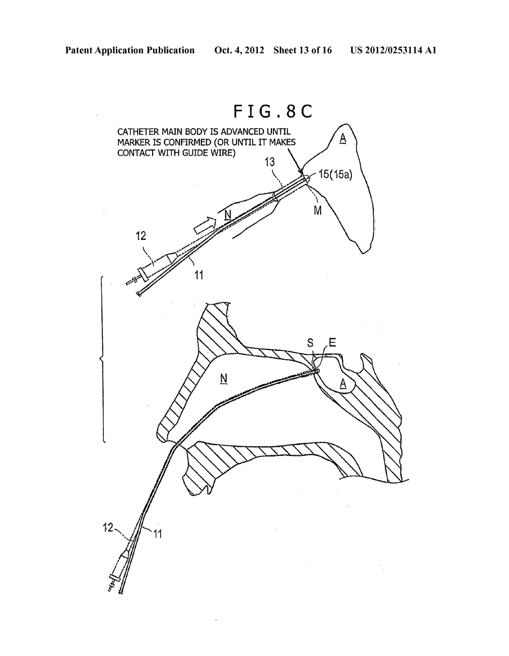 OTORHINOLARYNGOLOGICAL TREATMENT DEVICE AND METHOD - diagram, schematic, and image 14