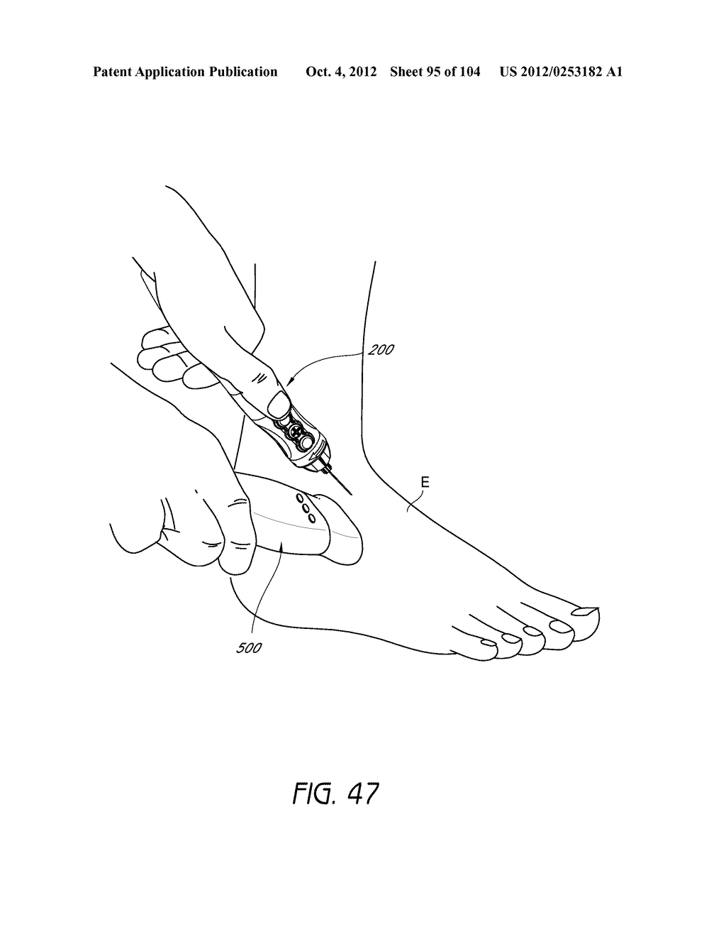 IMAGING-GUIDED ANESTHETIC INJECTION METHOD - diagram, schematic, and image 96