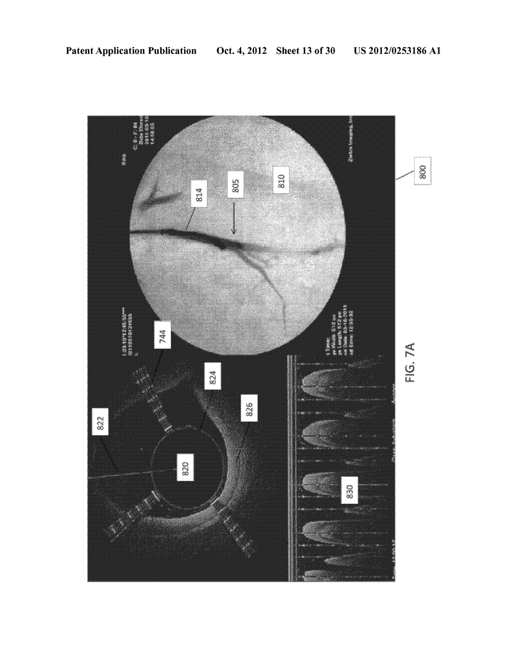 OCCLUSION-CROSSING DEVICES, IMAGING, AND ATHERECTOMY DEVICES - diagram, schematic, and image 14