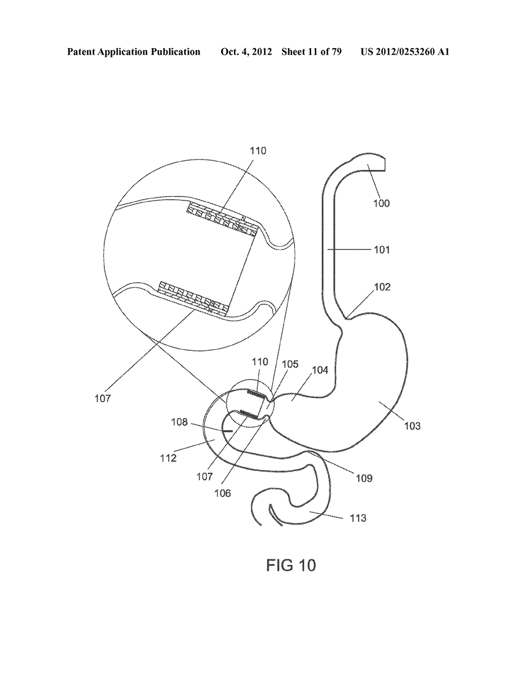 GASTROINTESTINAL PROSTHESES - diagram, schematic, and image 12