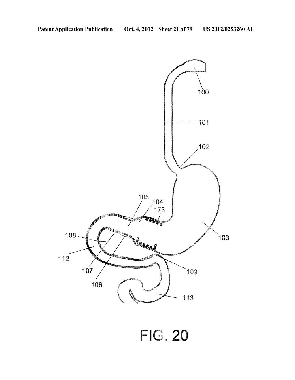 GASTROINTESTINAL PROSTHESES - diagram, schematic, and image 22