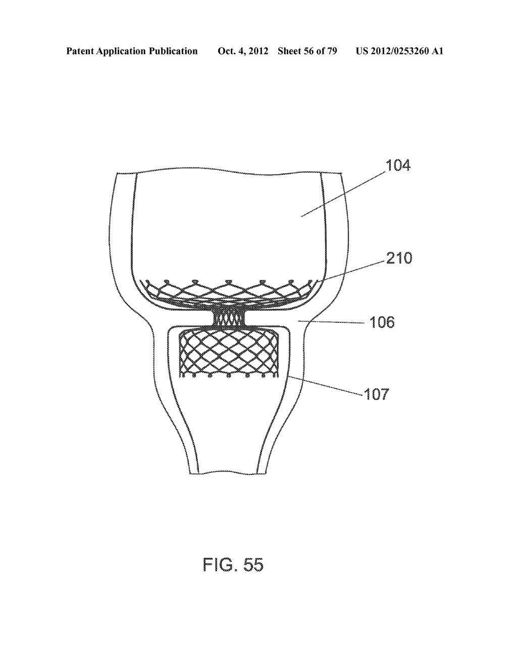 GASTROINTESTINAL PROSTHESES - diagram, schematic, and image 57