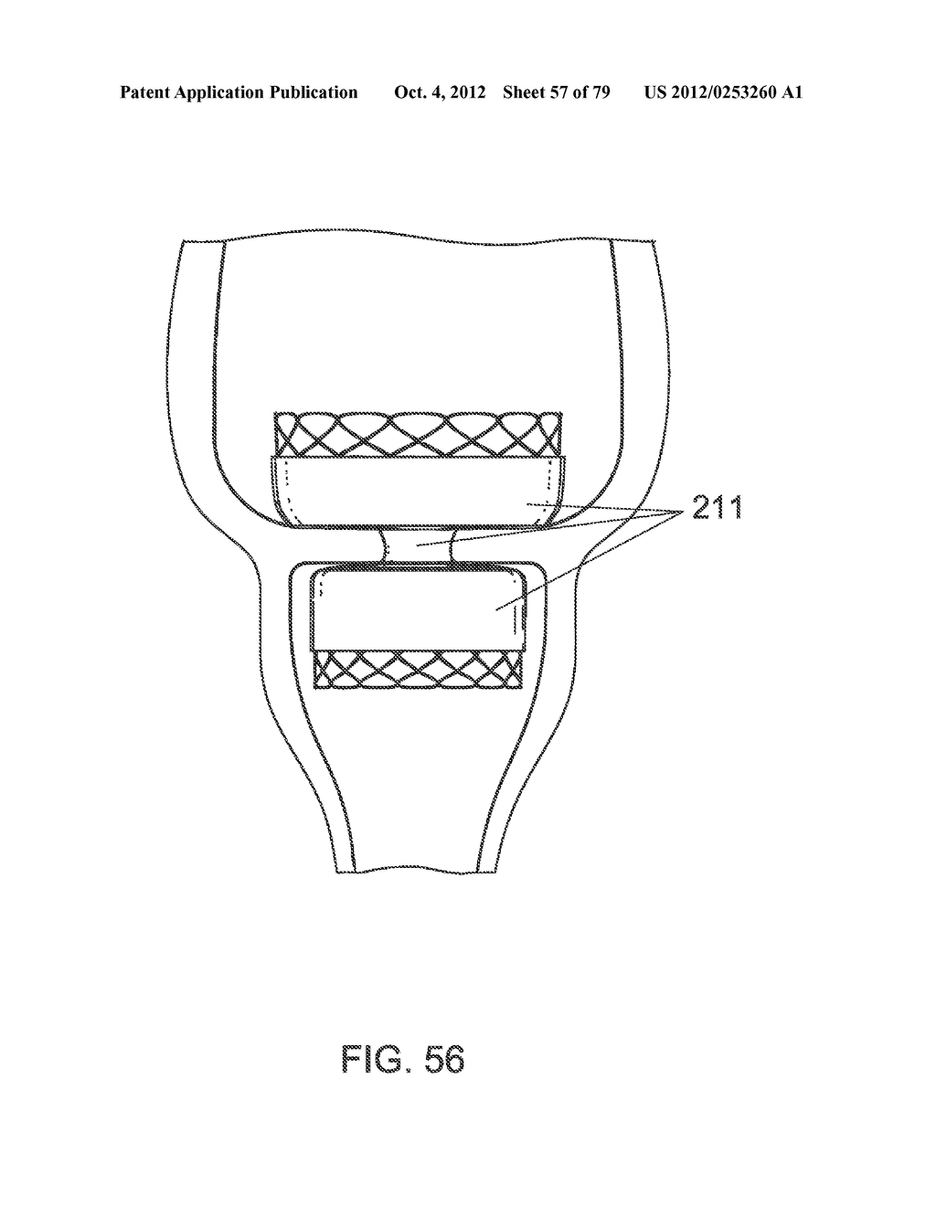 GASTROINTESTINAL PROSTHESES - diagram, schematic, and image 58