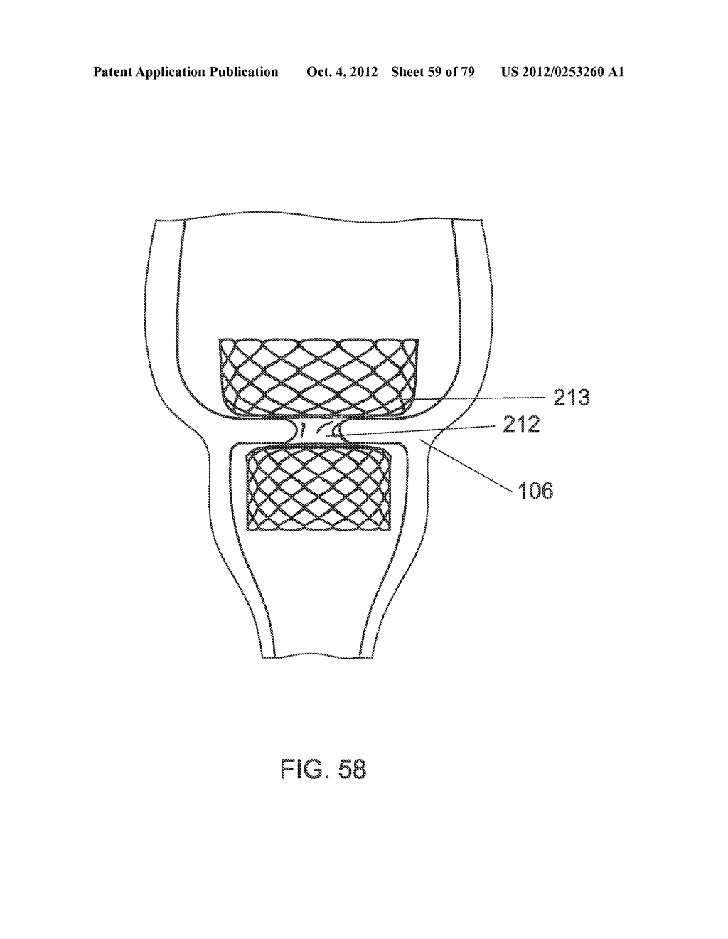 GASTROINTESTINAL PROSTHESES - diagram, schematic, and image 60